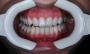 a close up of a person 's teeth with a mouth guard .