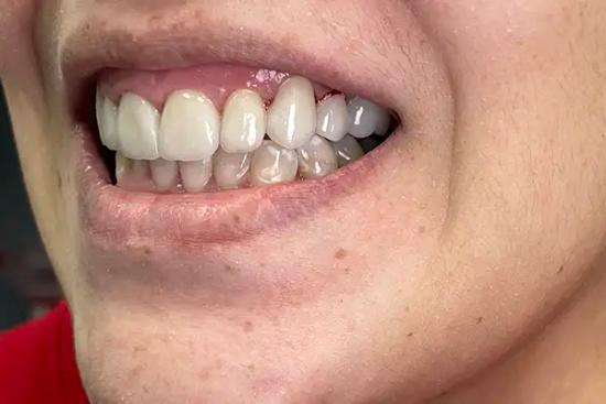 a close up of a person 's teeth with a smile on their face .