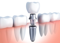 an illustration of a dental implant with a crown on top