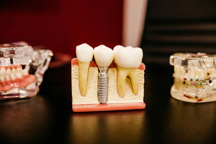 a model of a dental implant between two tooth models on a table .