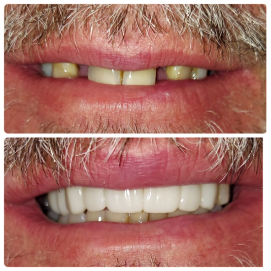 a before and after photo of a man 's teeth