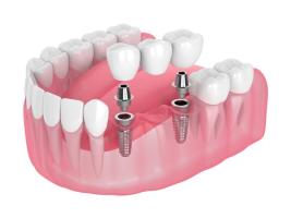3D model of an implant-supported dental bridge.