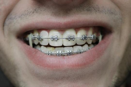 a close up of a man 's mouth with braces on his teeth .