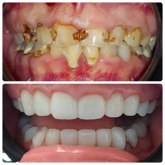 a before and after picture of a person 's teeth .