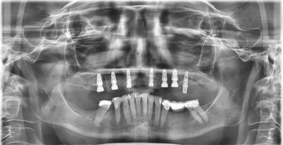 a panoramic x-ray of a person 's teeth with dental implants .