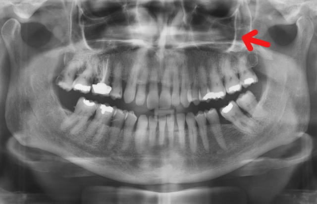 an x-ray of a person 's teeth with a red arrow pointing to a tooth