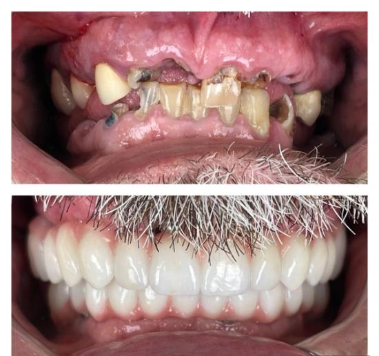 a before and after picture of a man 's teeth .