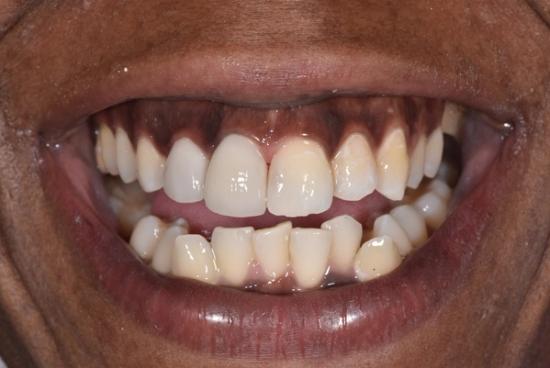 a close up of a person 's teeth with a missing tooth .