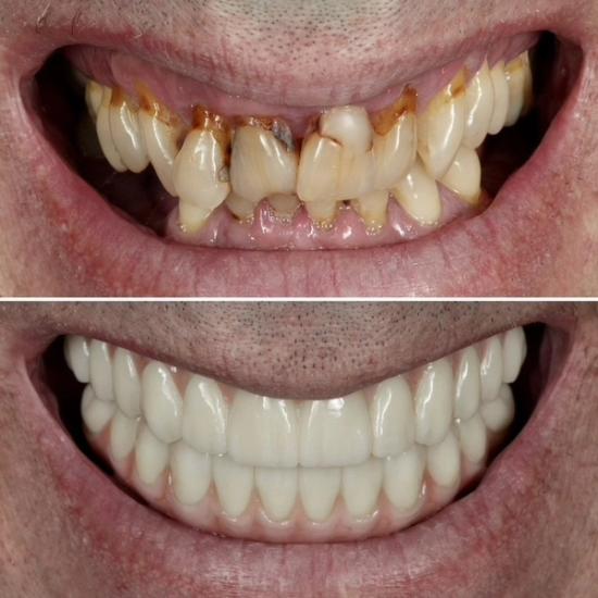 a before and after photo of a man 's teeth .