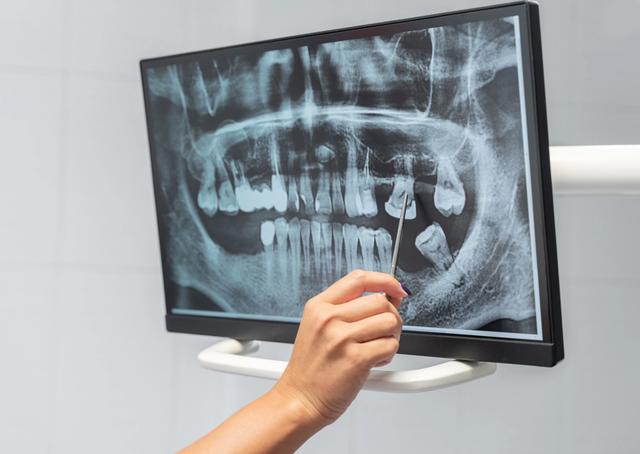 a person is pointing at an x-ray of a person 's teeth on a computer screen .