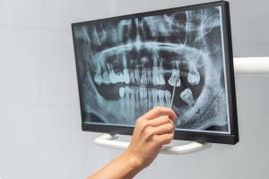 a person is pointing at an x-ray of a person 's teeth on a computer screen .