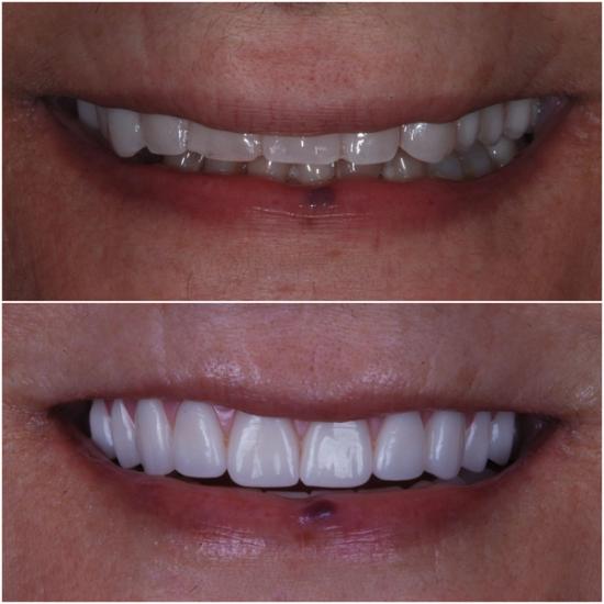 Before and after photos of a smile: Top shows uneven, discolored teeth; bottom shows straight, bright white teeth.