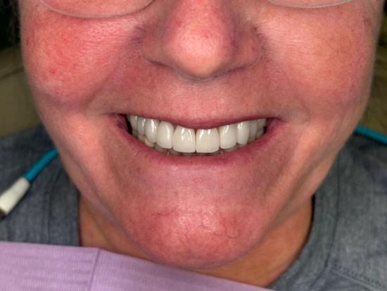 a close up of a woman 's smile with white teeth .