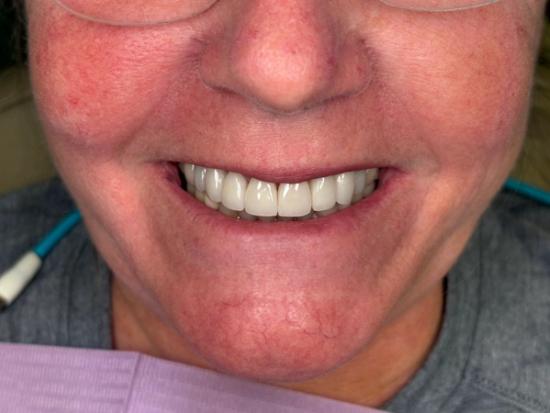 a close up of a woman 's smile with white teeth .