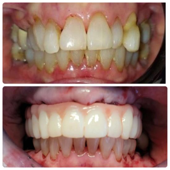 a before and after picture of a person 's teeth