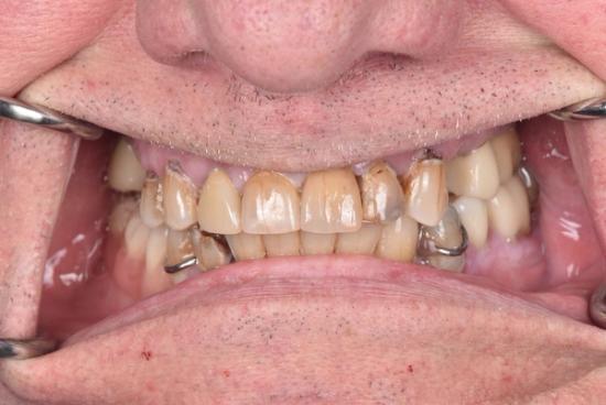 a close up of a man 's teeth with metal braces .