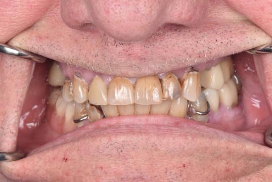 a close up of a man 's teeth with metal braces .