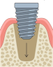 Illustration of a dental implant being screwed into the jawbone.