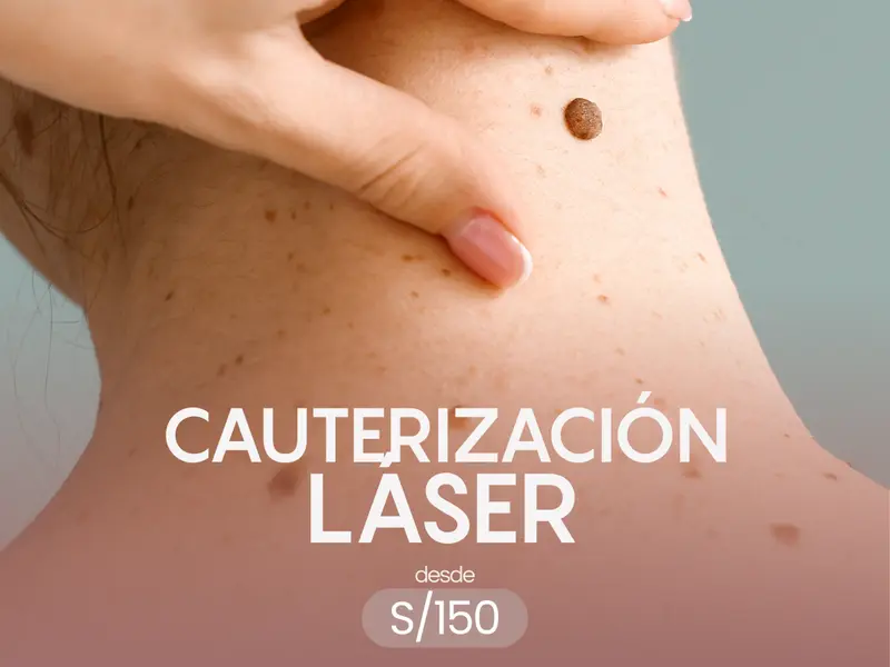 Cauterización Láser desde S/150 - In Luxury Experience