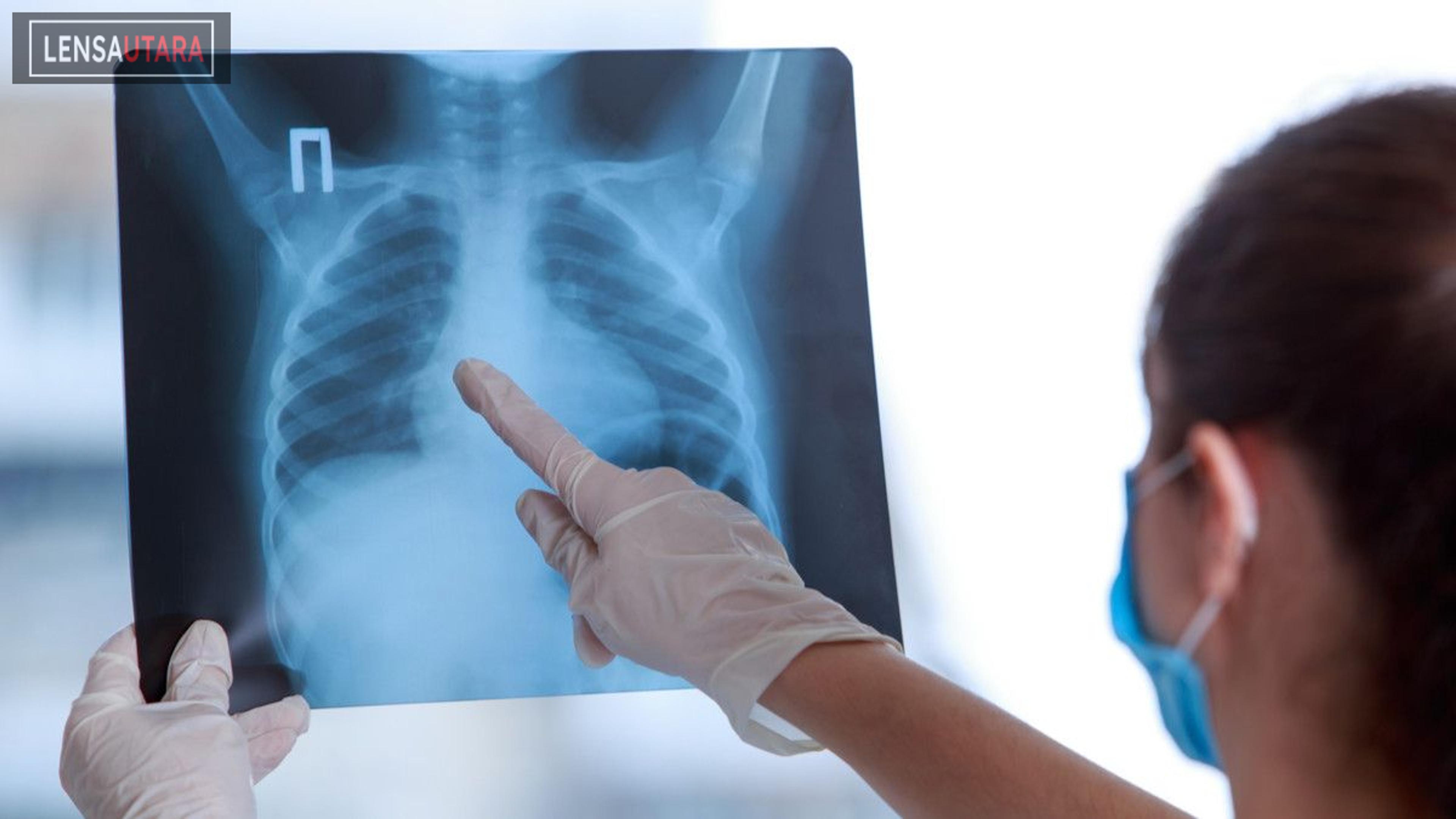Gaya Hidup Buruk Tingkatkan Risiko Pneumonia