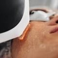 Lumecca IPL Photofacial