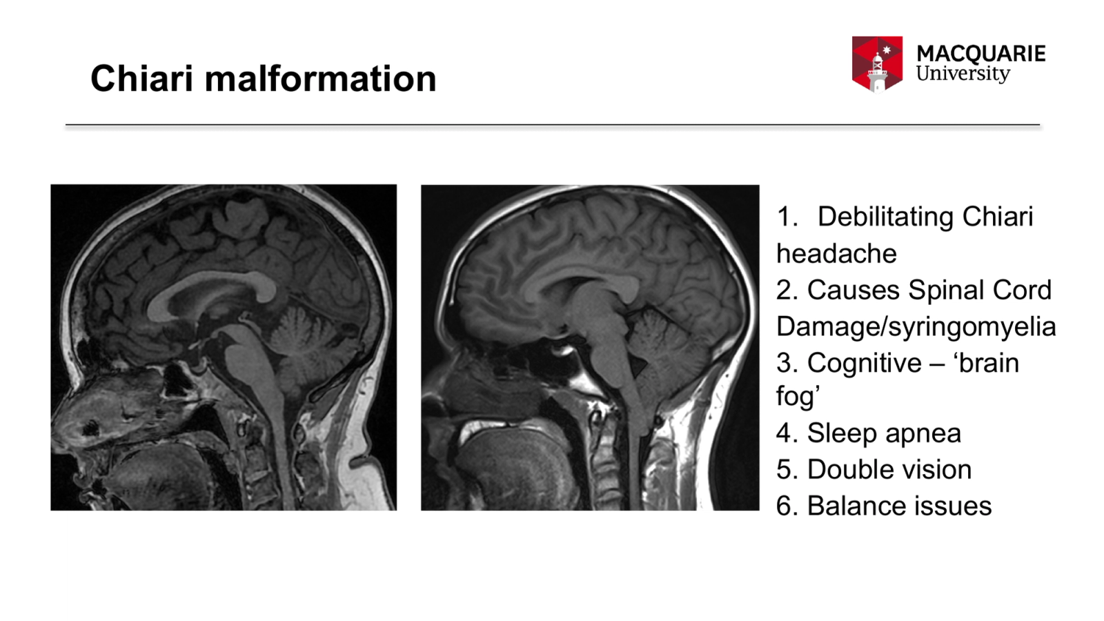 Chiari malformation
Debilitating Chiari
headache
2. Causes Spinal Cord
Damage/syringomyelia
3. Cognitive – ‘brain fog’
4. Sleep apnea
5. Double vision
6. Balance issues