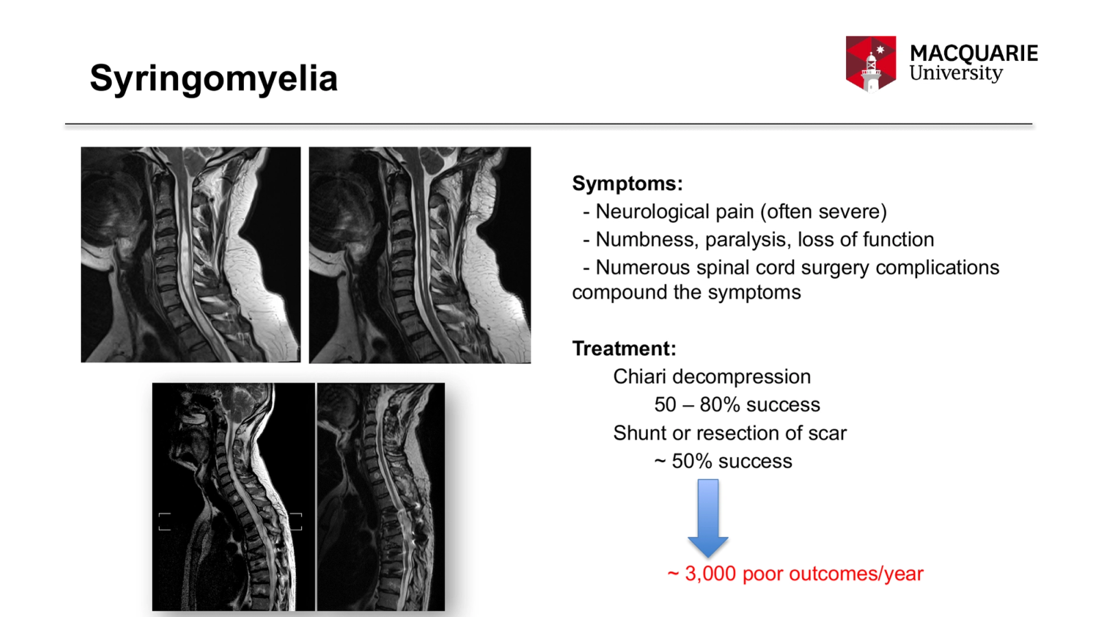 Syringomyelia
Symptoms:
- Neurological pain (often severe)
- Numbness, paralysis, loss of function
- Numerous spinal cord surgery complications compound the symptoms
Treatment:
Chiari decompression
50 – 80% success
Shunt or resection of scar
~ 50% success
~ 3,000 poor outcomes/year