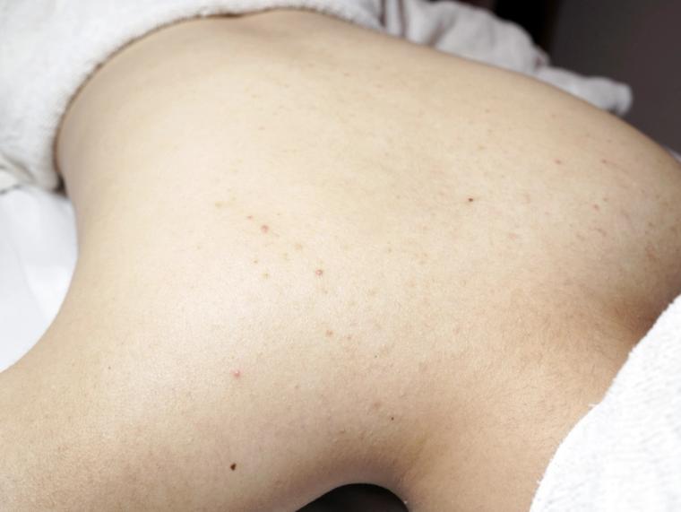 體驗前的背部——莫名狂冒痘痘和閉鎖性粉刺,一摸就是一粒一粒的,穿露背的衣服都沒自信。