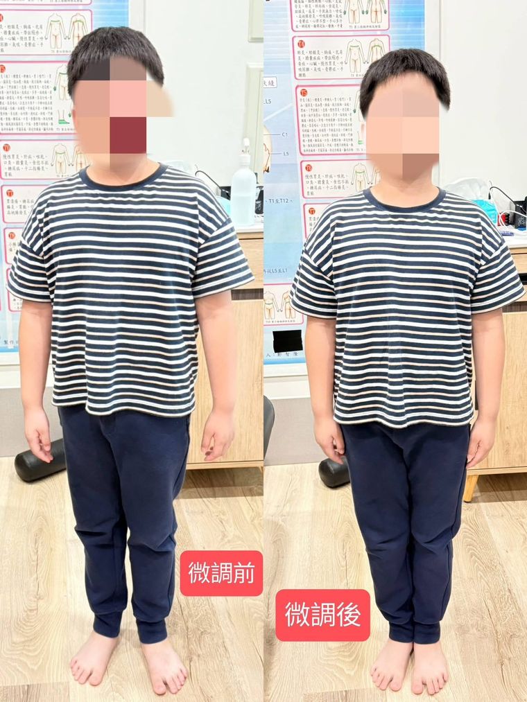 現場記錄下微調前後的雙腳與站姿對照(正面、背面),讓家長自己看