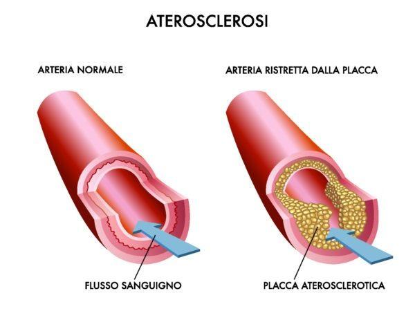 Le 5 cause organiche del disturbo erettile