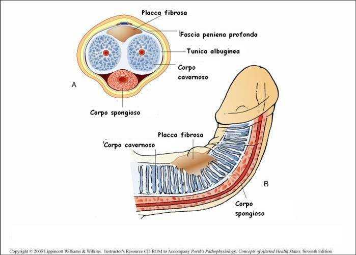 La malattia di Peyronie è tra le cause organiche del disturbo erettile