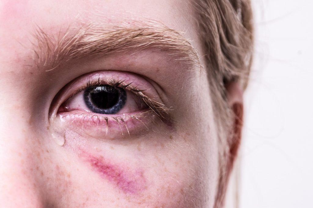 Pensieri e umore negativi sono sintomi del disturbo post-traumatico da stress