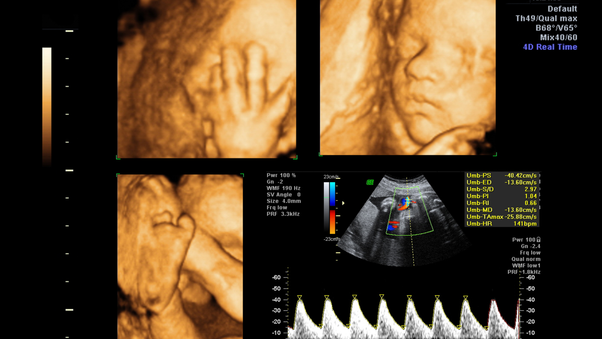 3D & 4D Fetal Scan