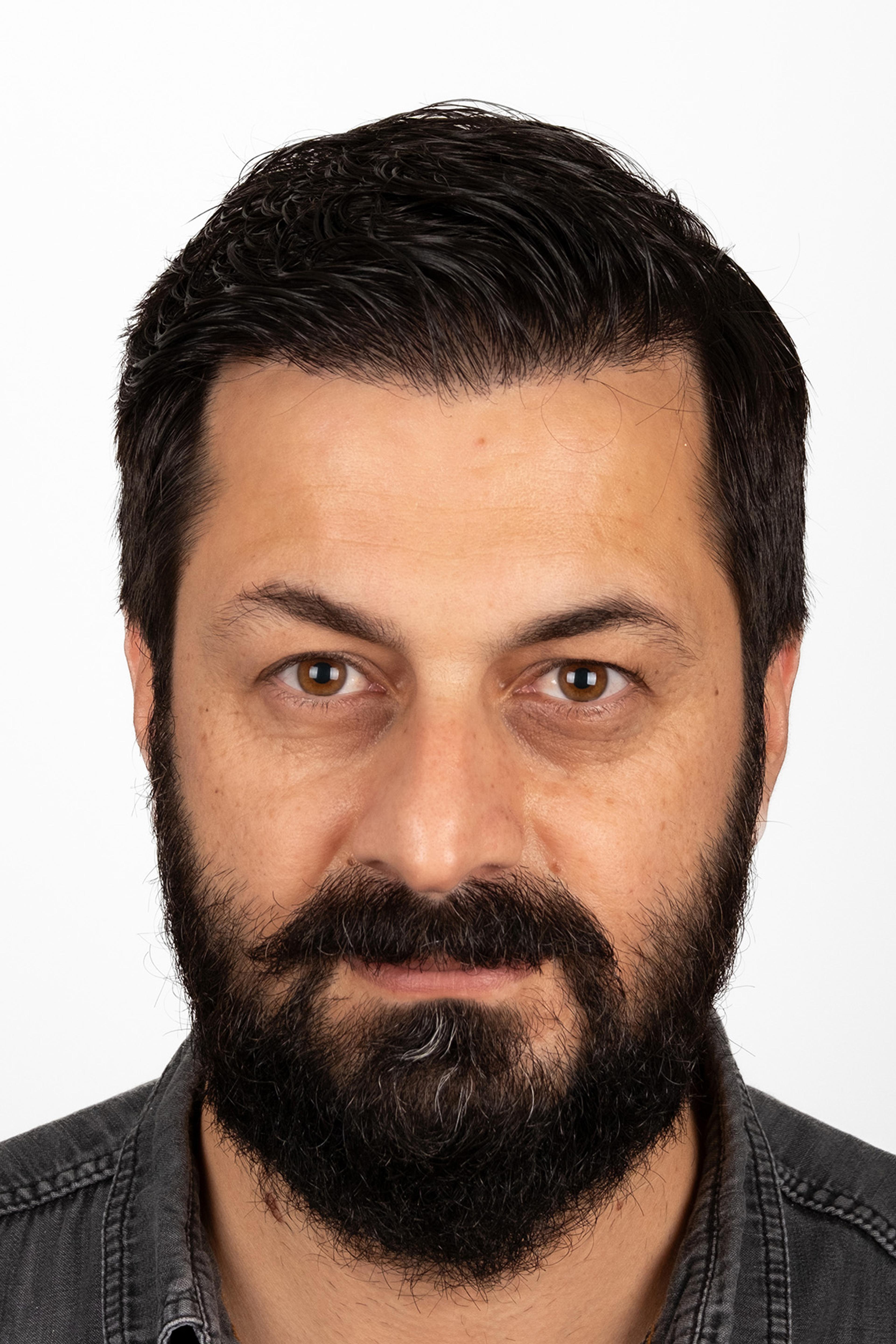 After – FUE & DHI