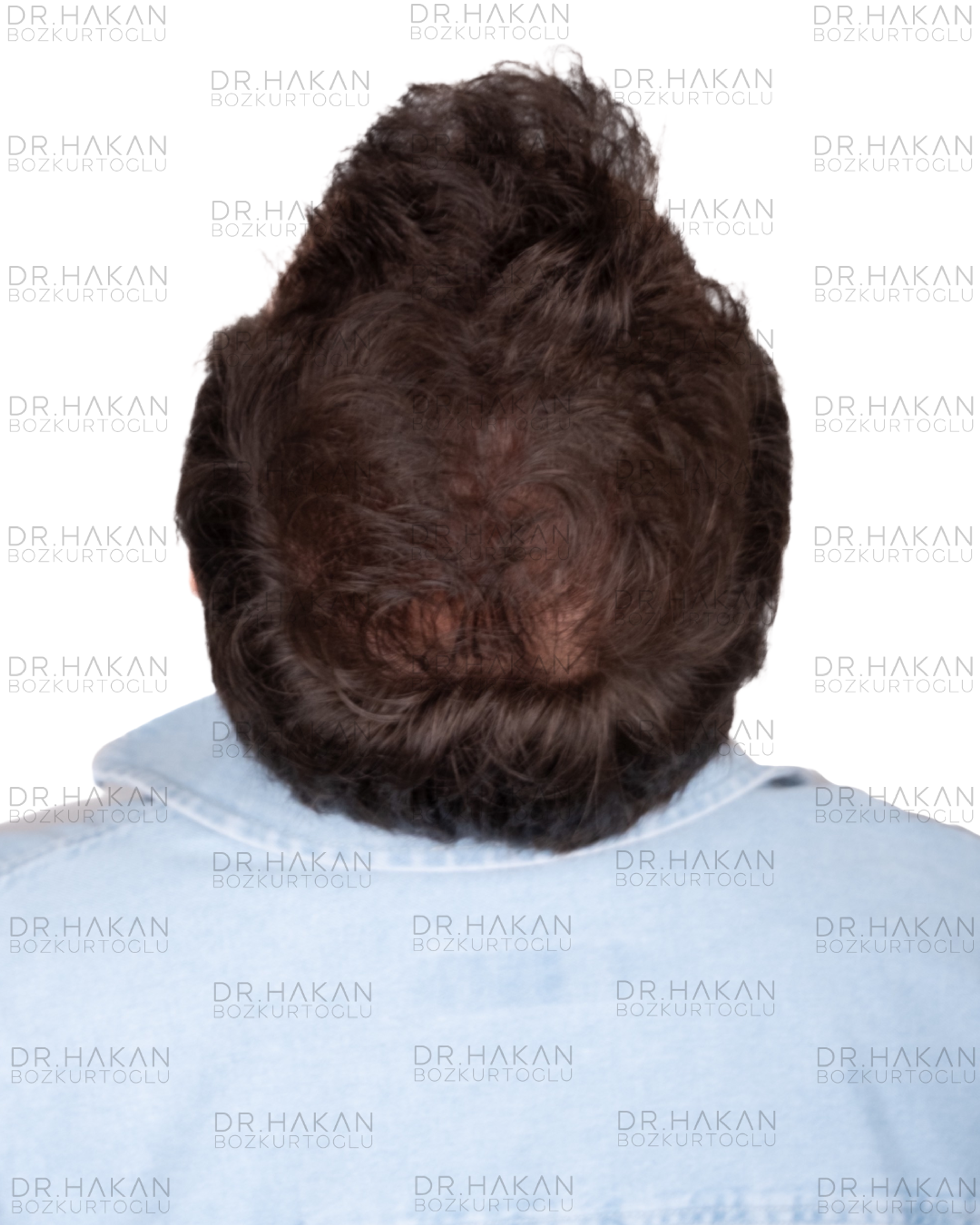 12 months dry hair