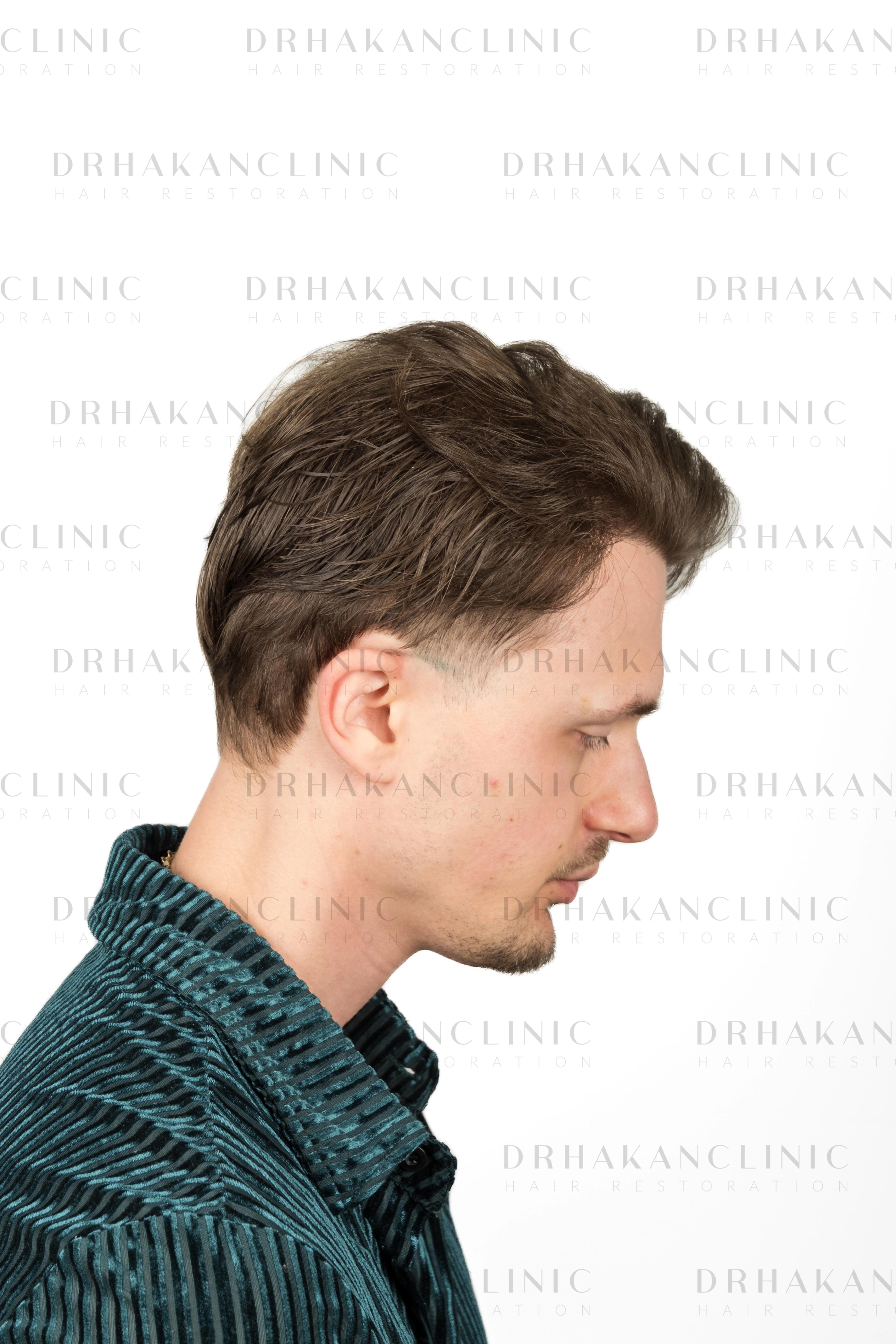 35 months post-op