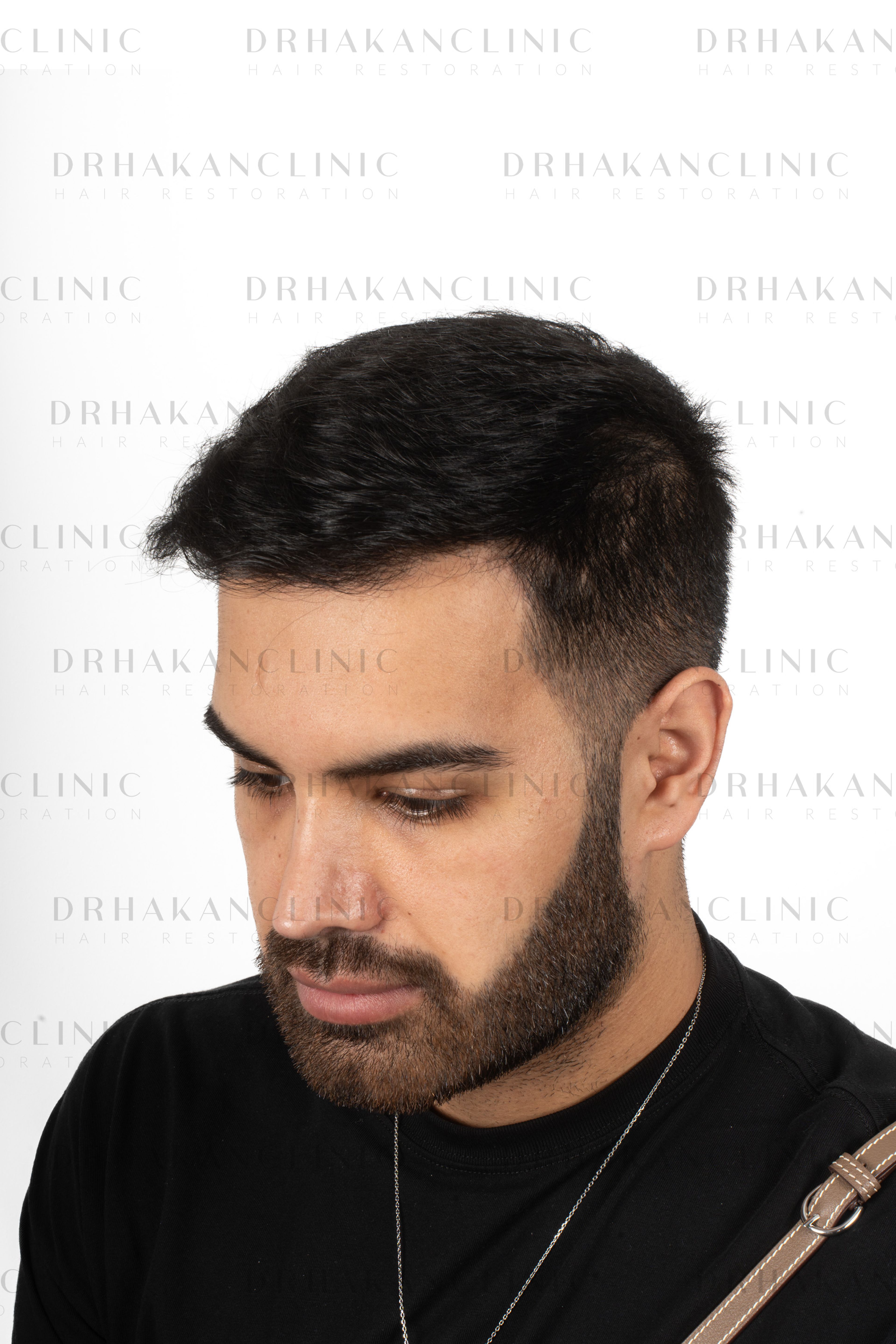 9 months post-op