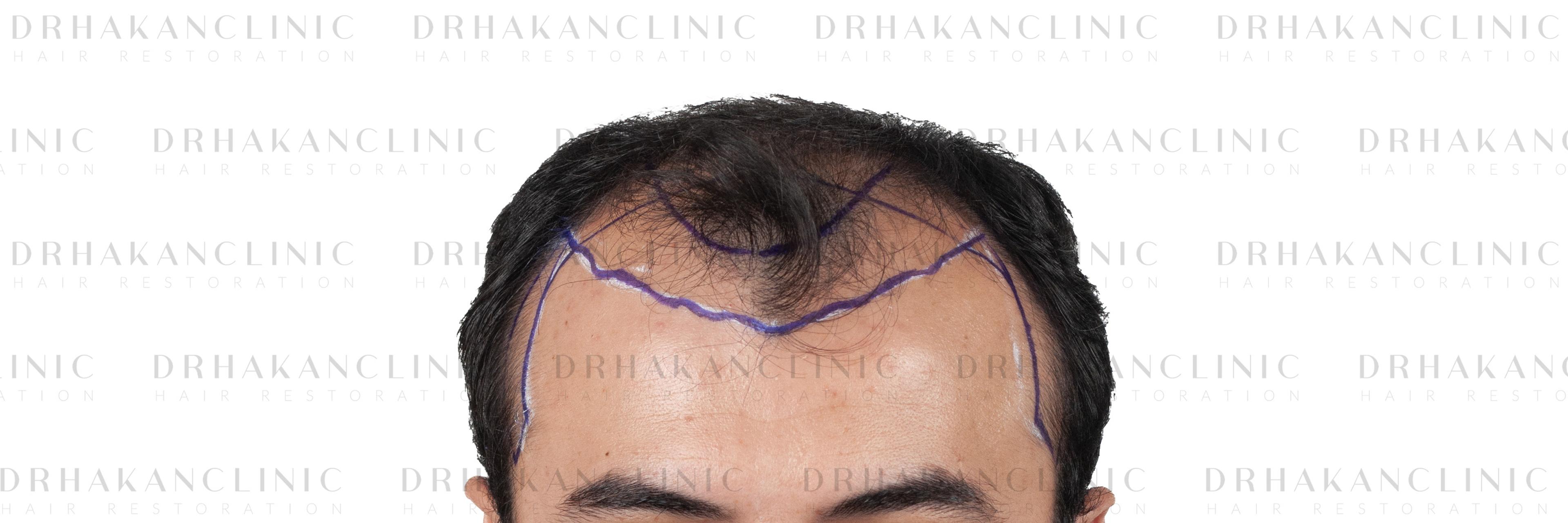 Before – FUE & DHI