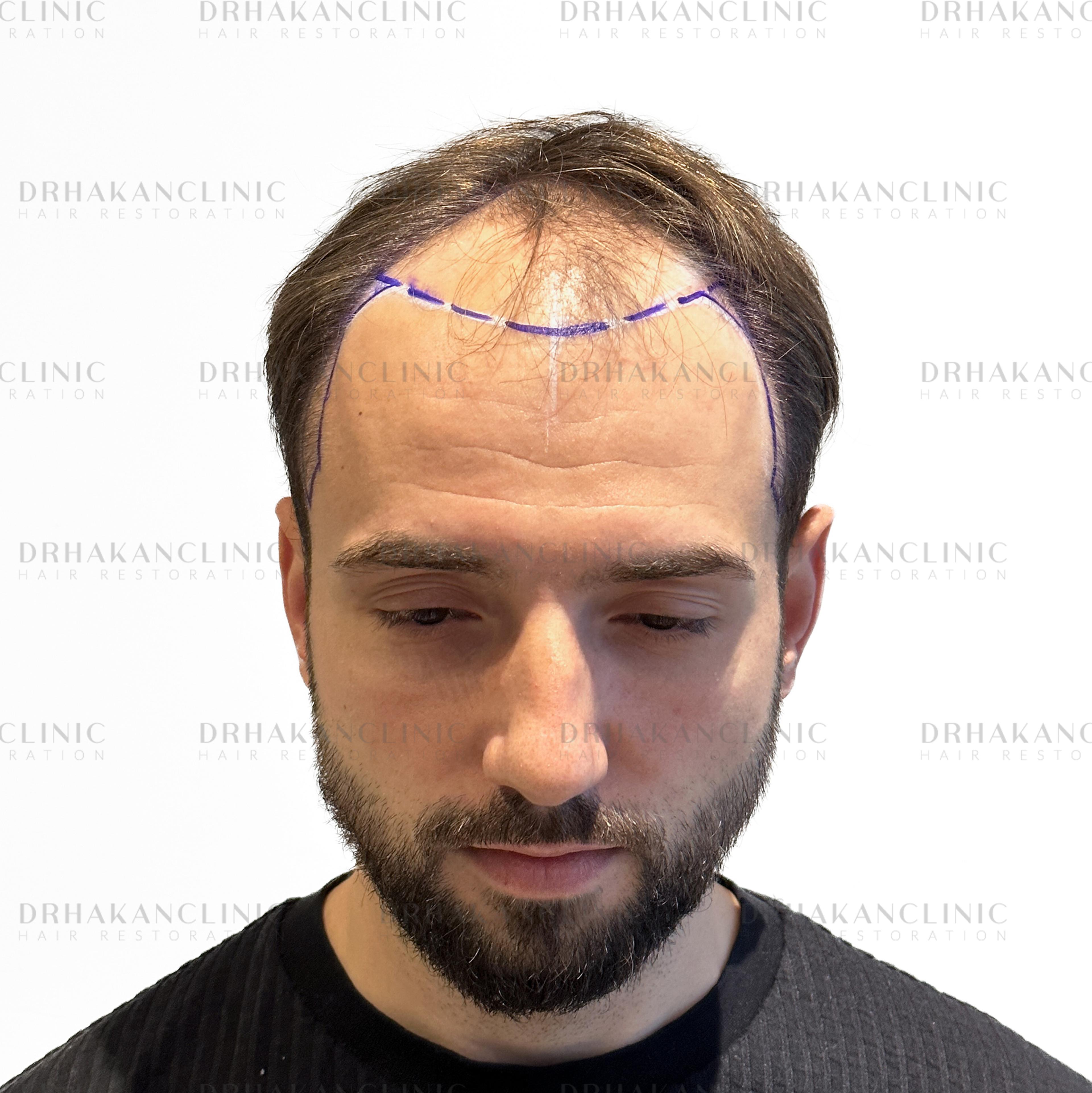 Before – FUE & DHI