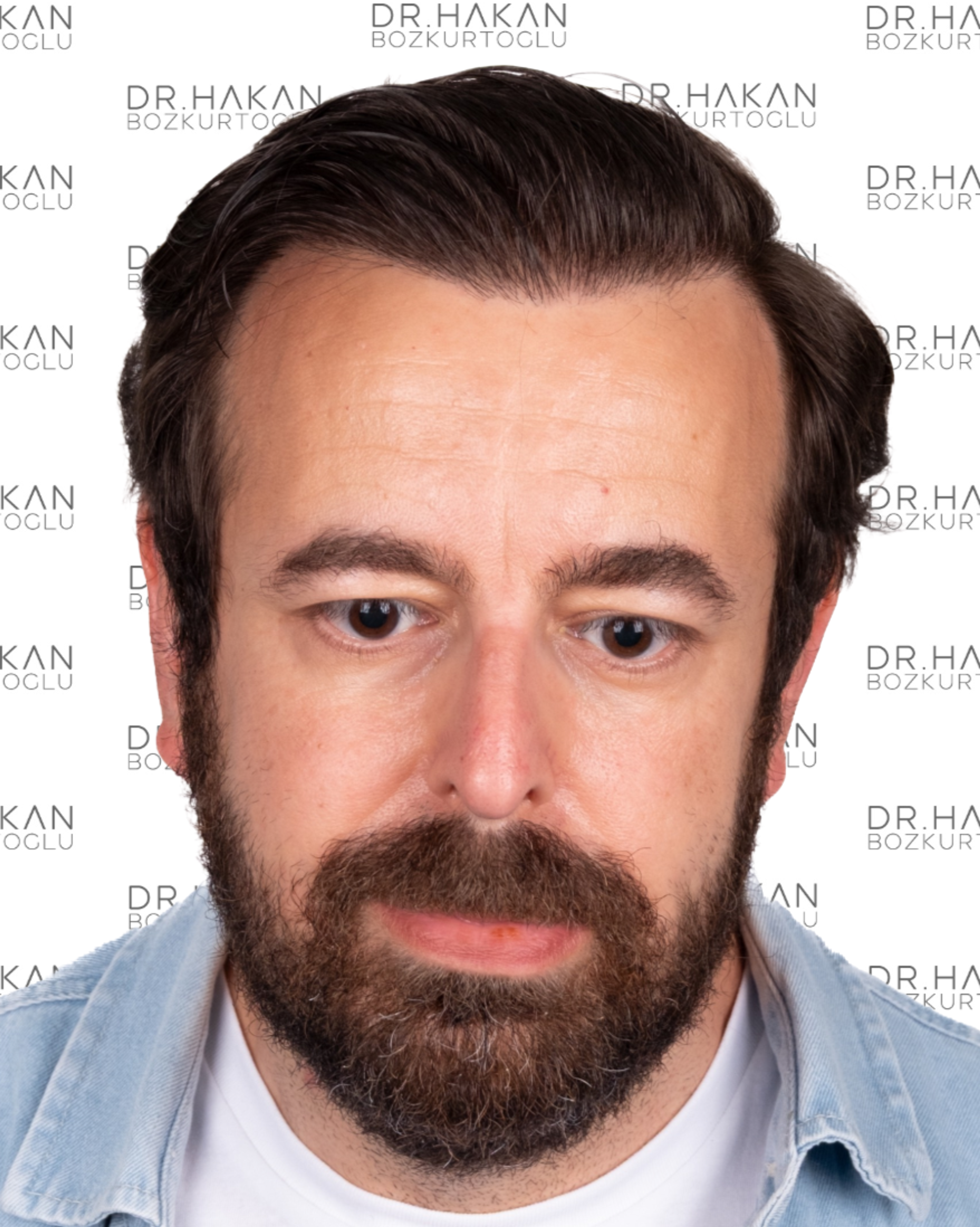 After – FUE & DHI