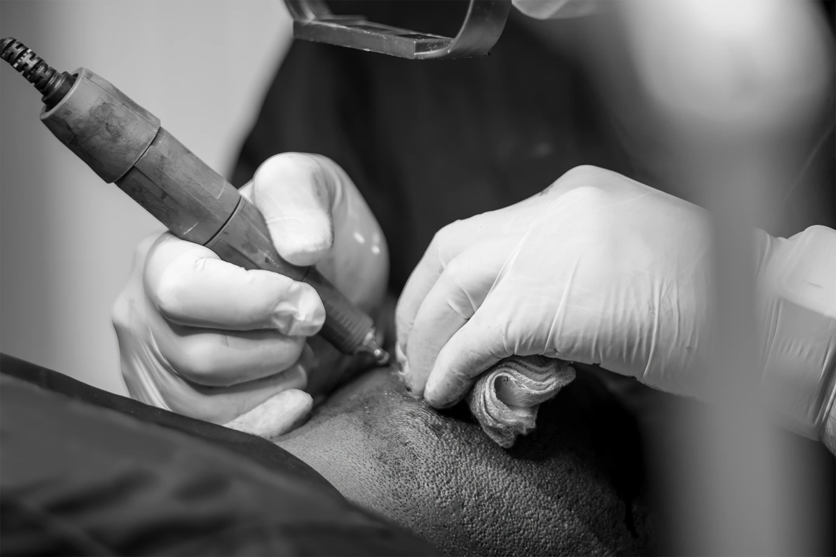 FUE vs. DHI – ¿Cuál es el mejor método de injerto capilar?