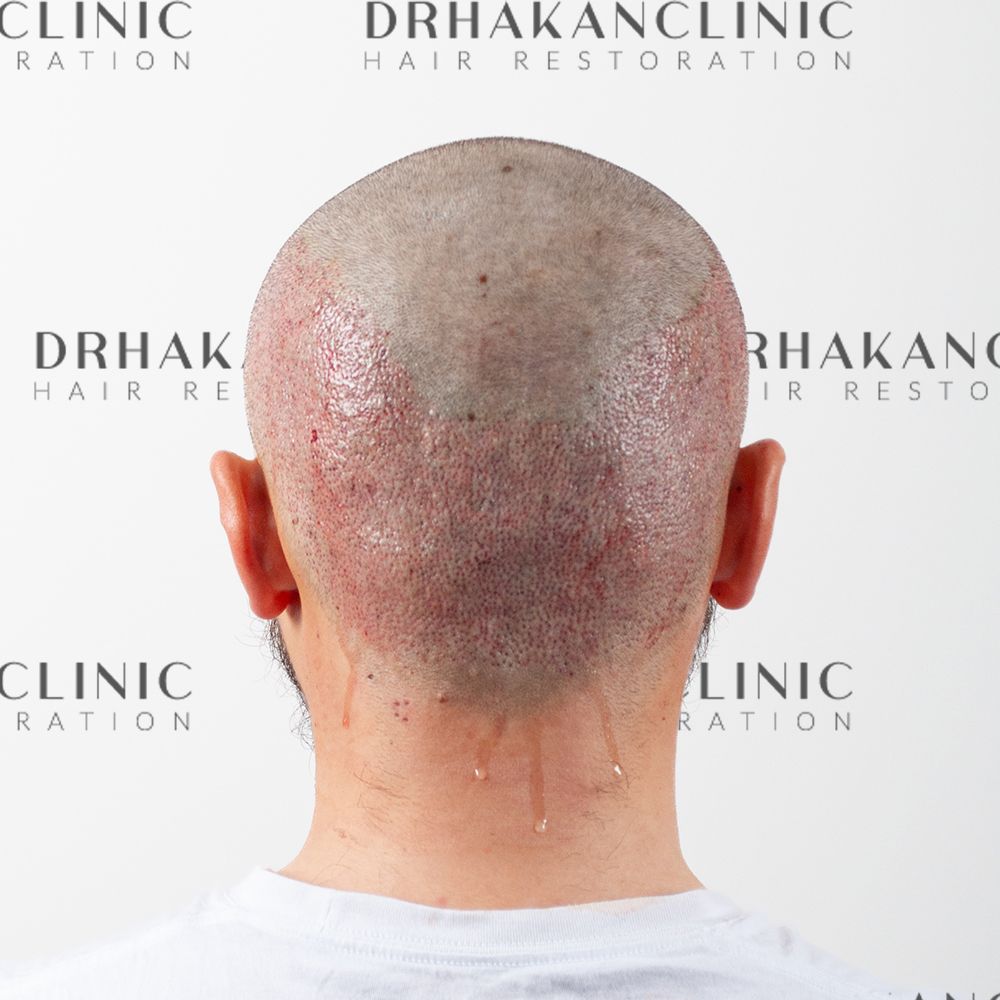 Donor area immediately after FUE hair transplant extraction showing clean punches and minimal trauma to the scalp