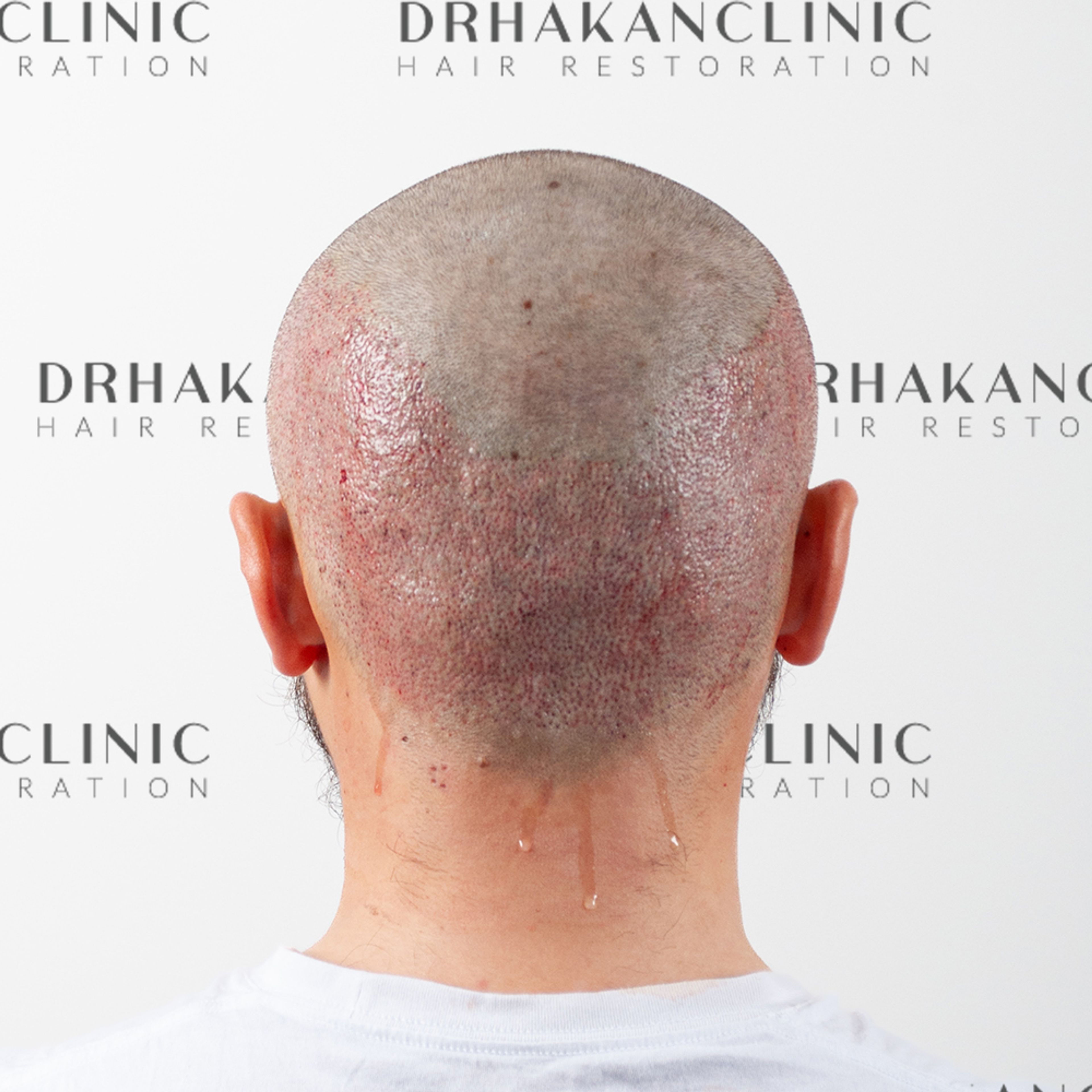 Donor area immediately after FUE hair transplant extraction showing clean punches and minimal trauma to the scalp