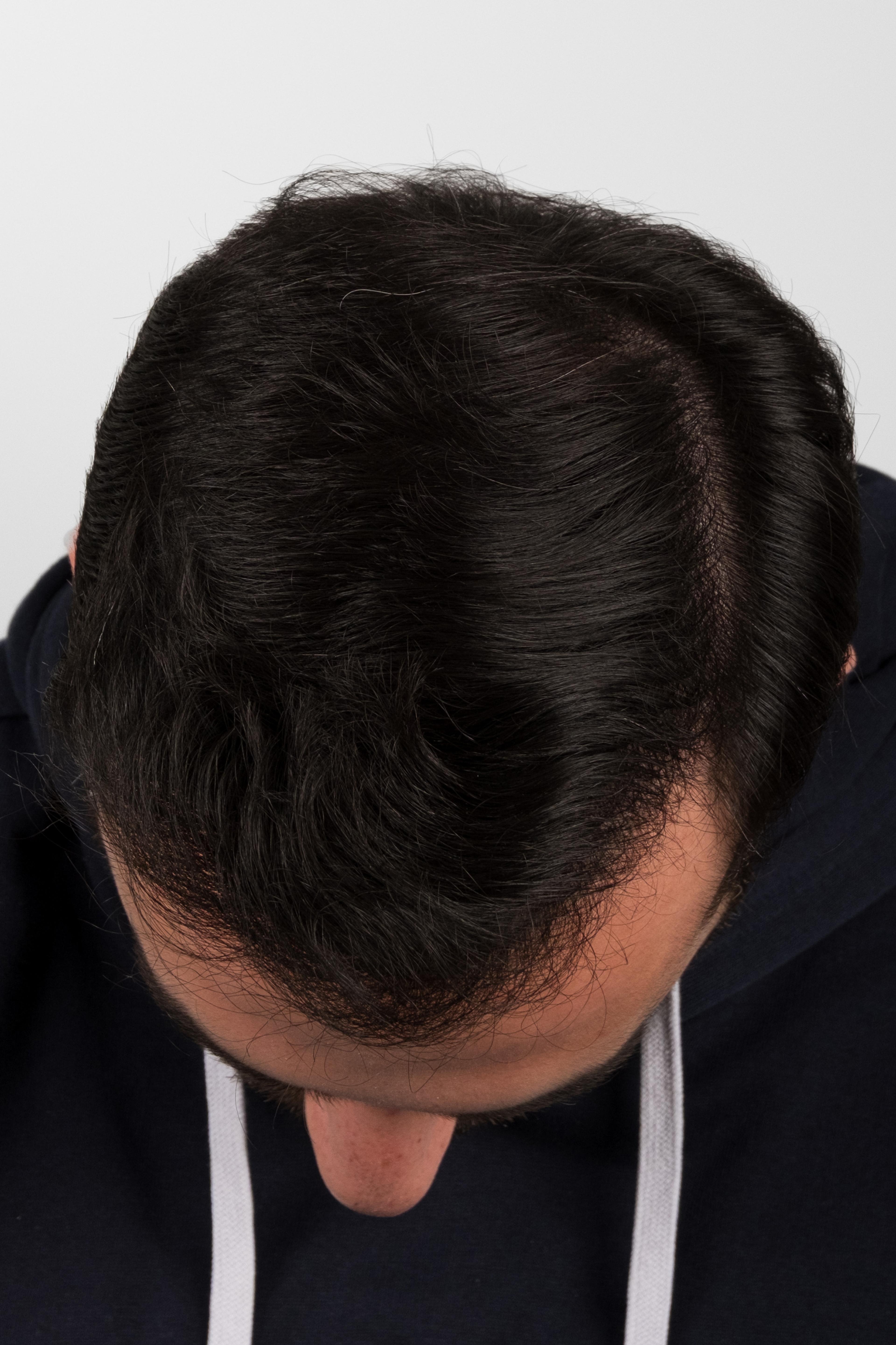 After – FUE & DHI