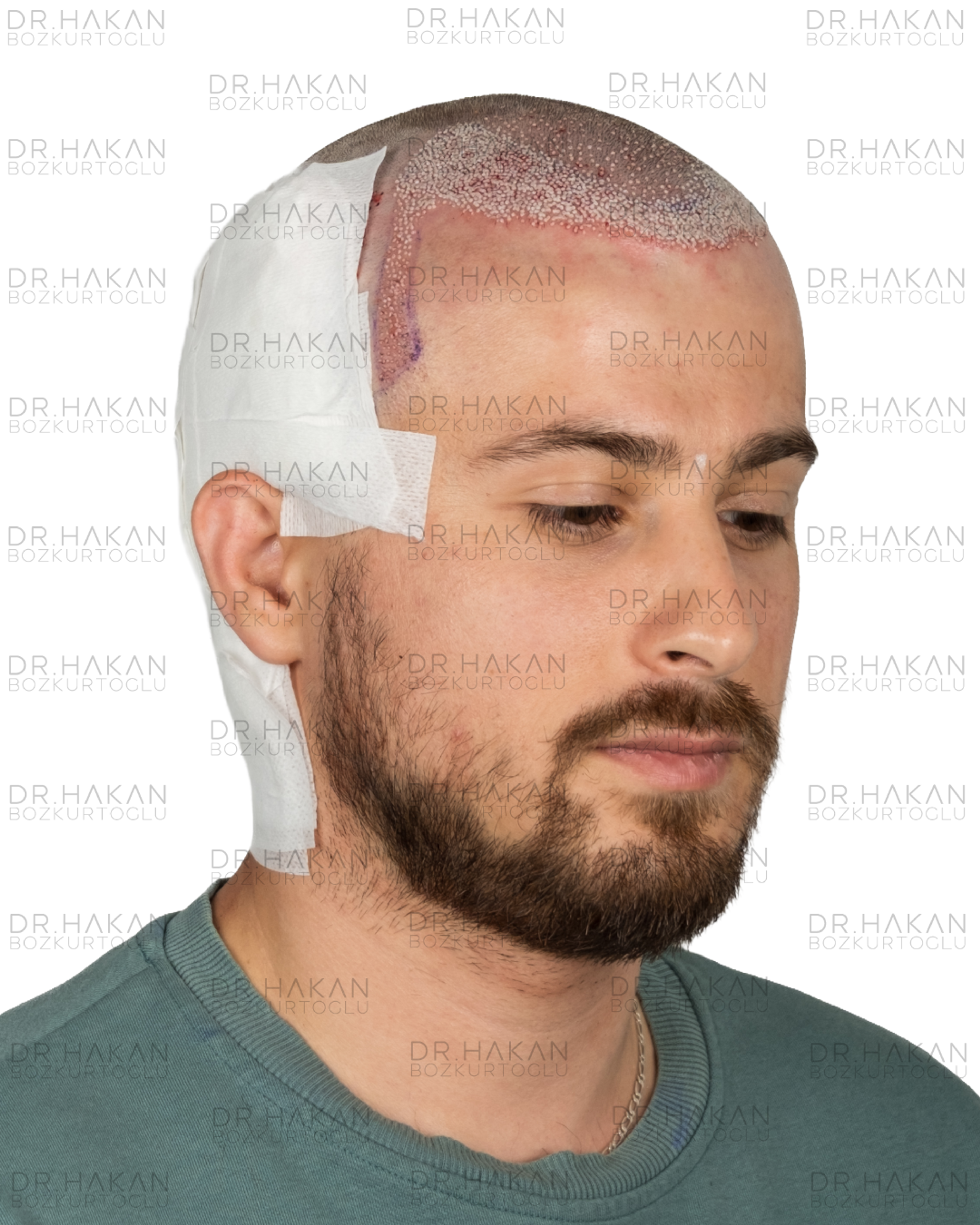 post-op