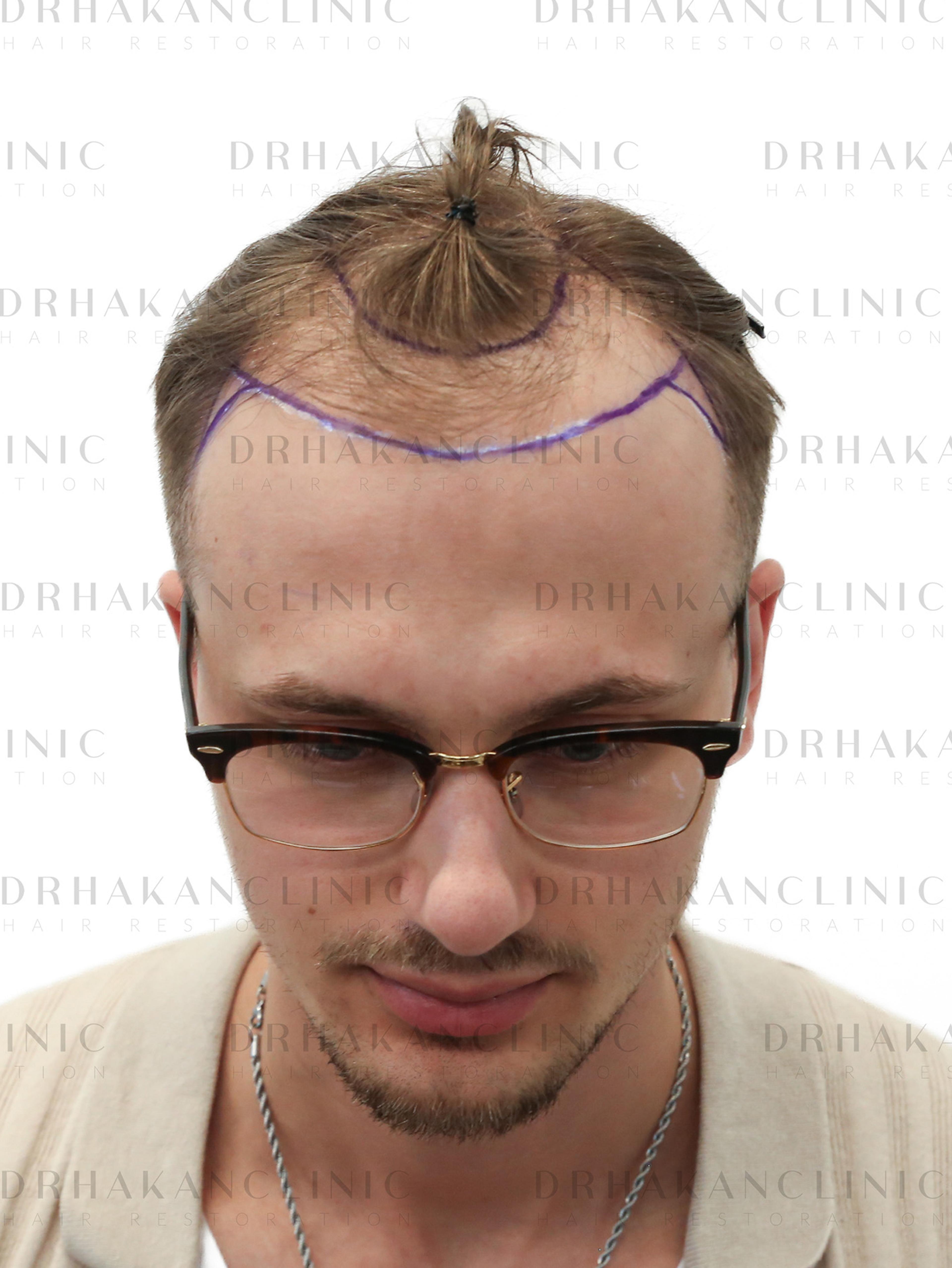 Before – FUE & DHI