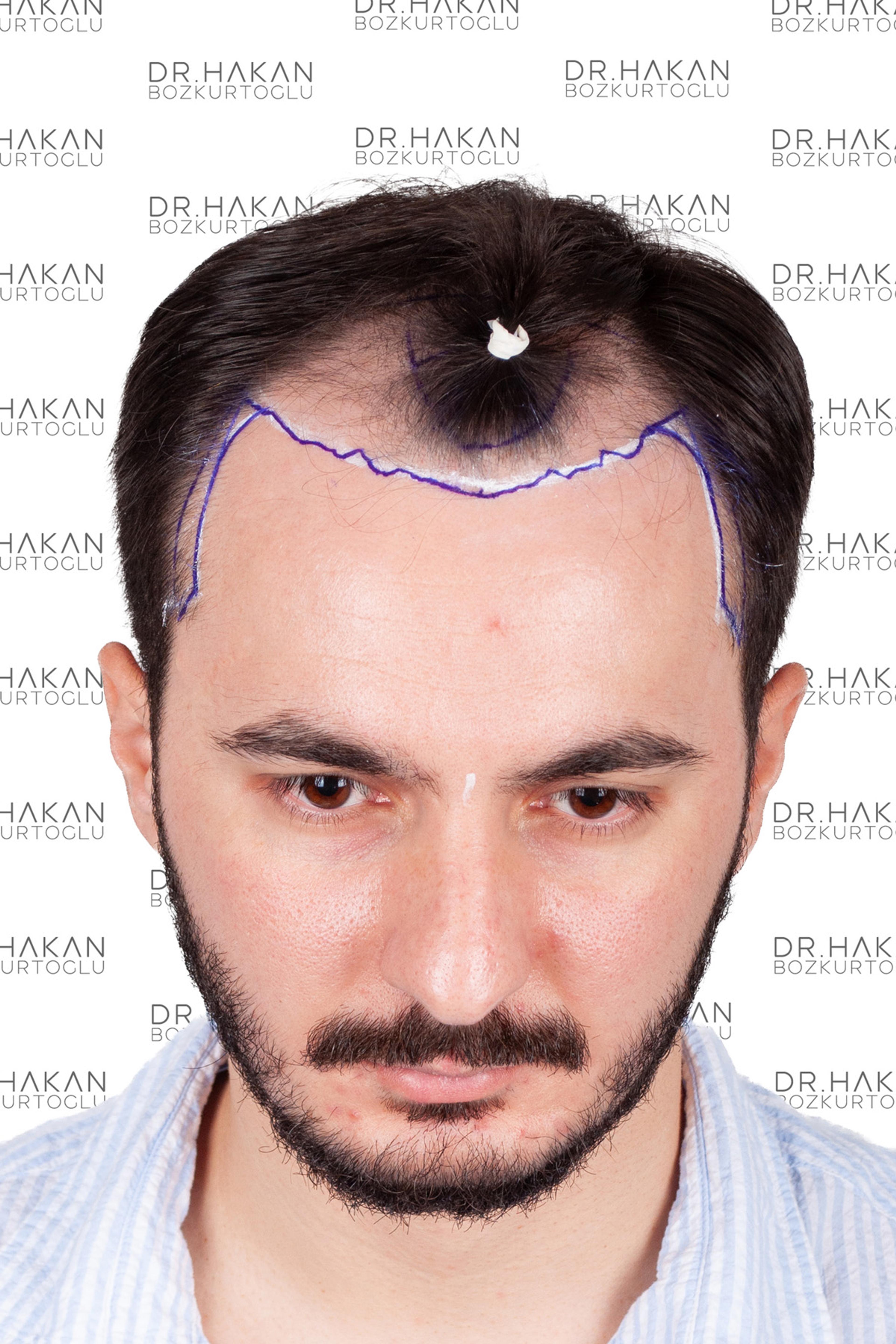 Before – FUE & DHI