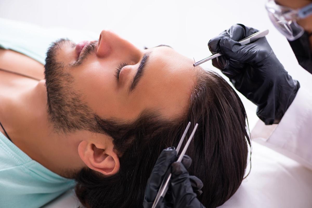 Trasplante de Cabello: Qué Esperar Durante la Recuperación