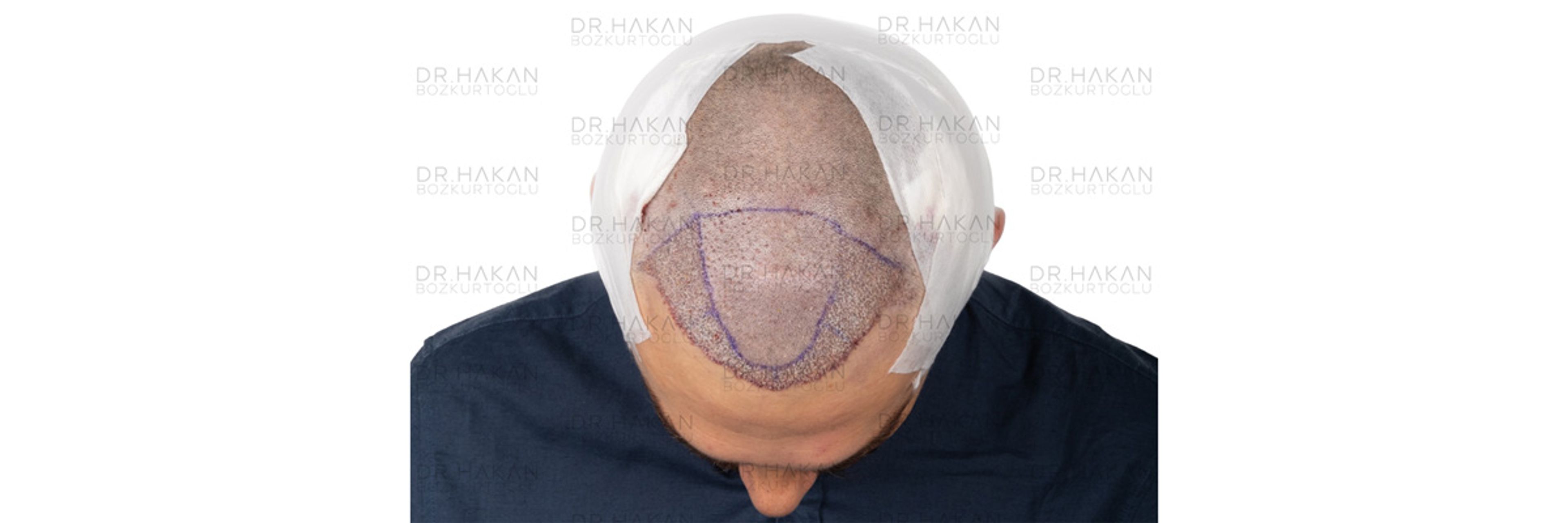 post-op