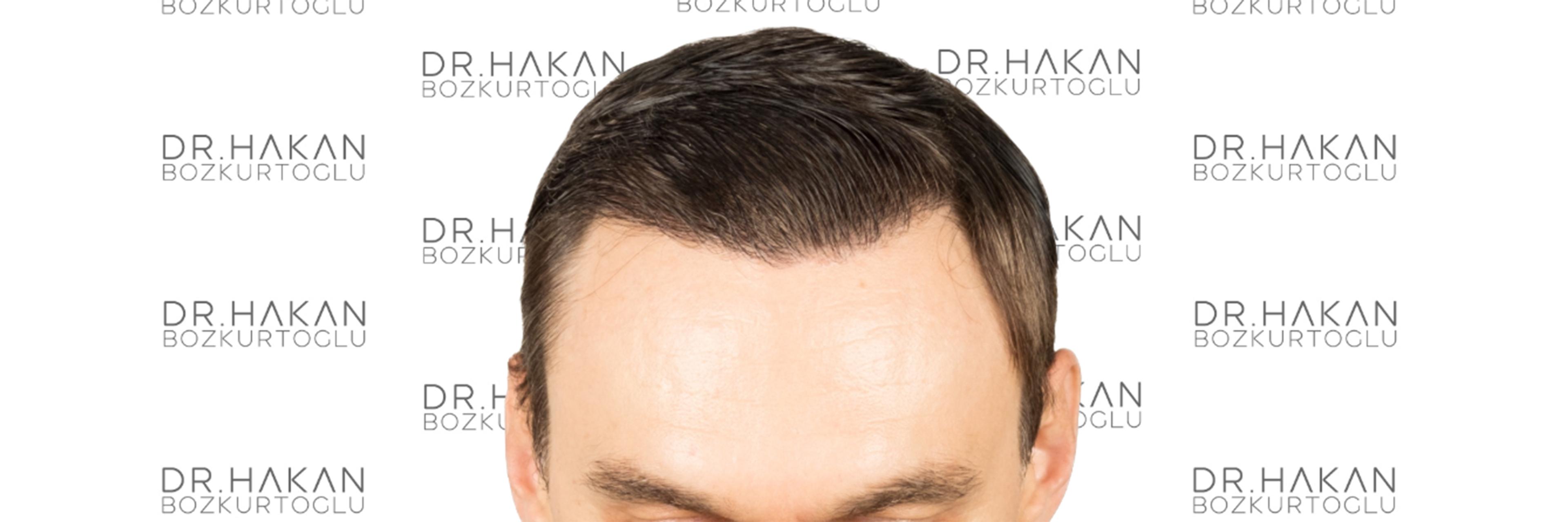 After – FUE & DHI